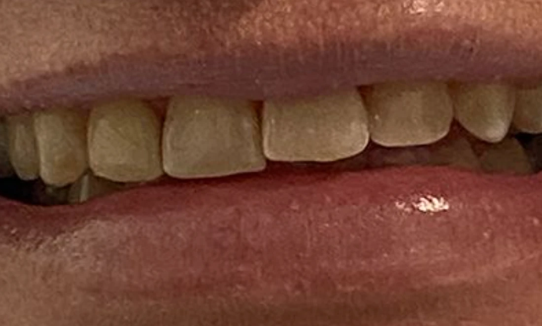 Cosmetic Smile Makeover — before